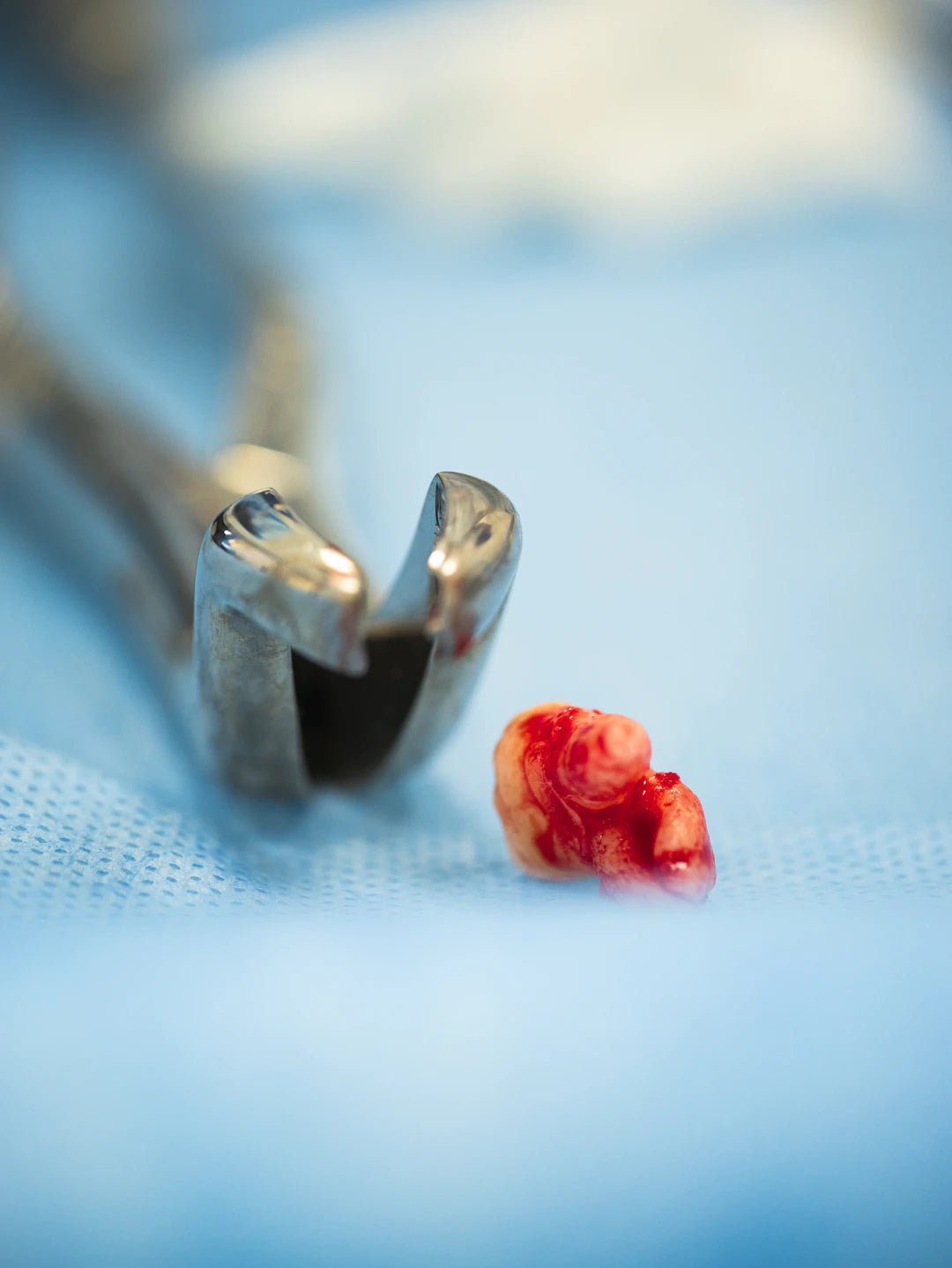 Dental Sutures: Understanding Common Complications - Dental Sutures