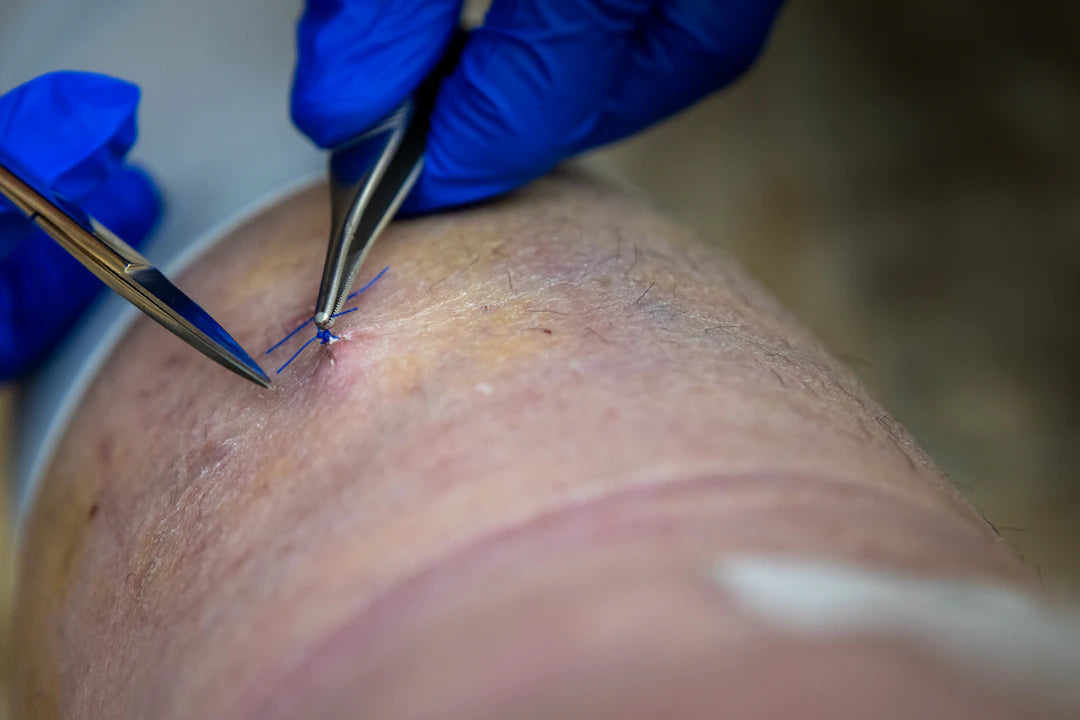 Coated Absorbable VICRYL Sutures for Precision Dental Care