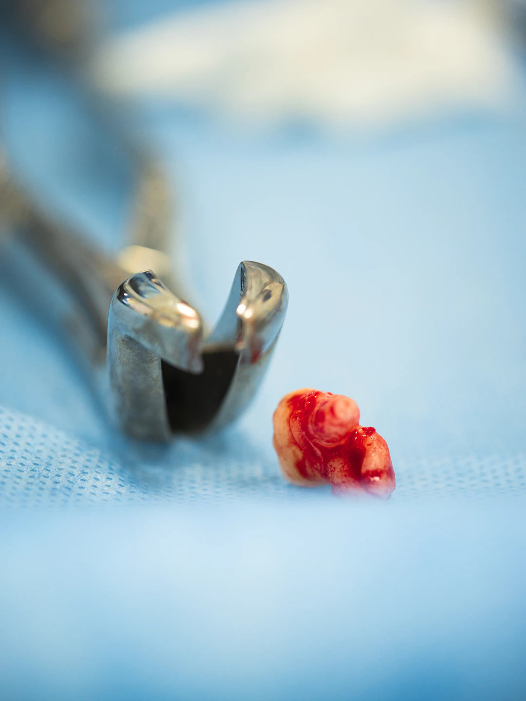 The Future of Dental Sutures: Trends and Predictions