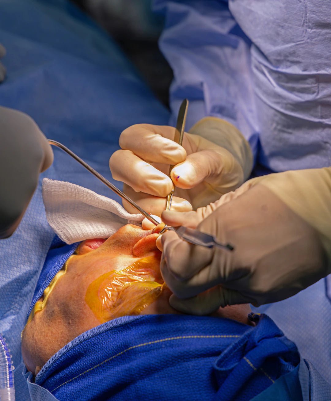The Essential Role of Suturing in Oral Surgery - Dental Sutures