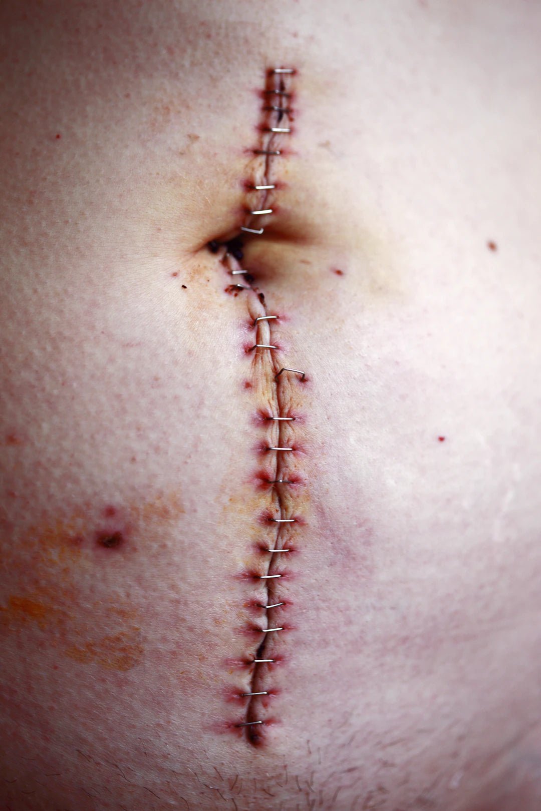 The Impact of Suturing on Patient Comfort - Dental Sutures