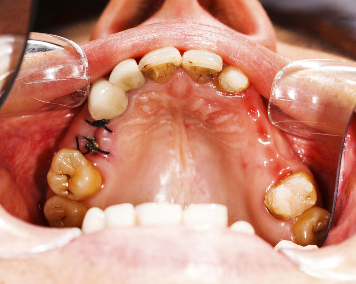 VICRYL Absorbable Sutures for Effective Dental Procedures