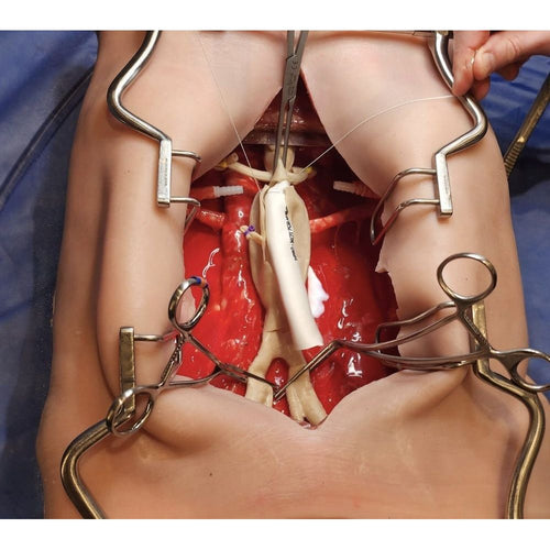 Precision Dermal Abdominal Aortic Aneurysm Model | AAA Surgical Training Simulator UK LL-TRN-0217